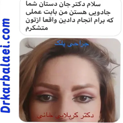 بلفاروپلاستی 