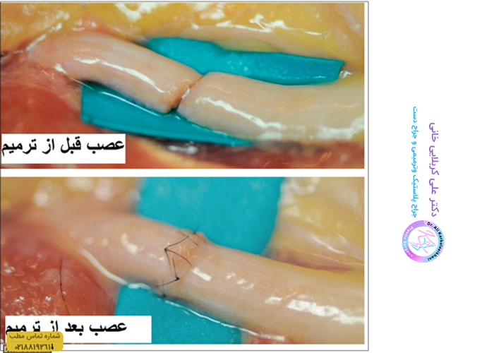 قبل و بعد ترمیمی عصب