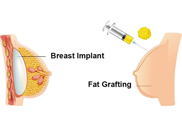 لیفت سینه و تزریق چربی به سینه