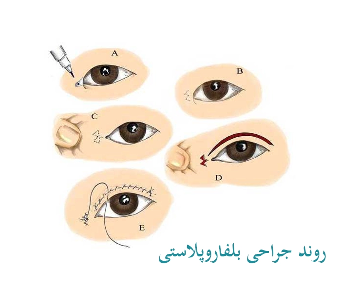 روش جراحی بلفاروپلاستی