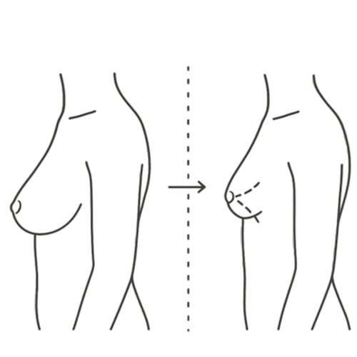 ماموپلاستی