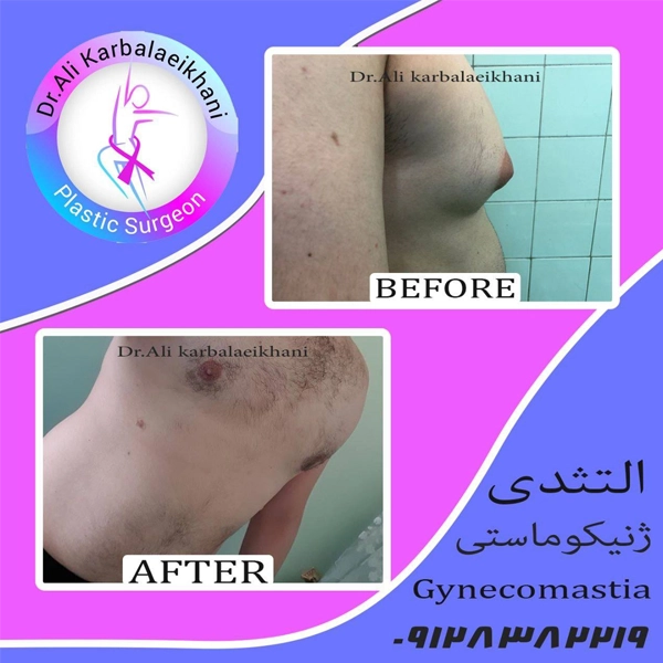 نمونه ژنیکوماستی