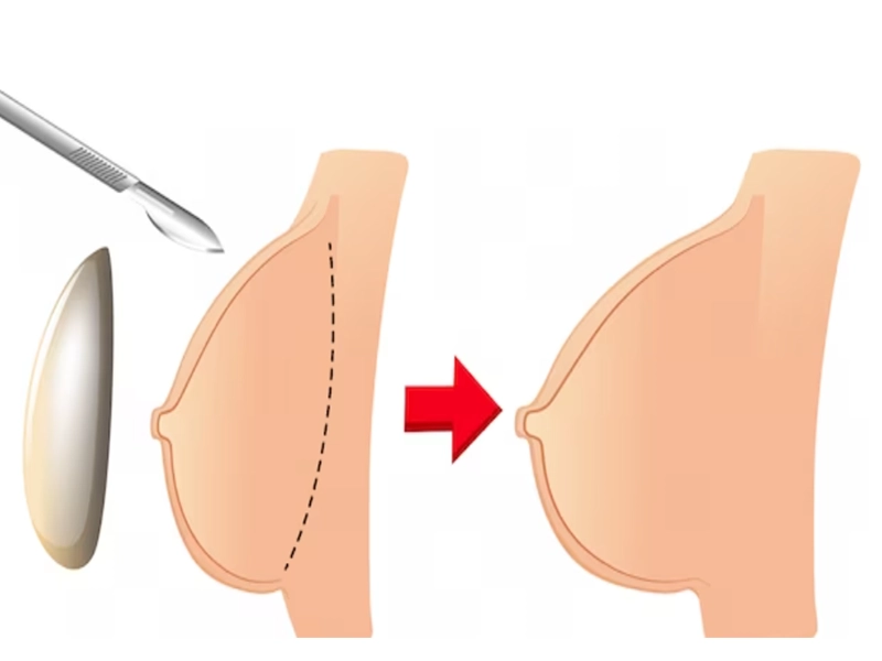 آیا پروتز سینه نیاز به تعویض دارد؟