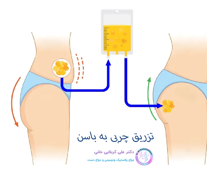  تزریق چربی به باسن