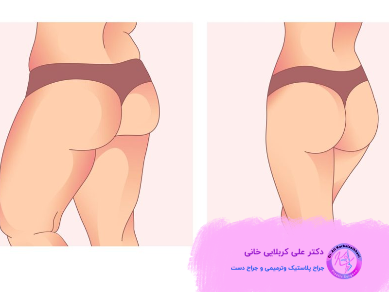 هزینه تزریق ژل و چربی به باسن
