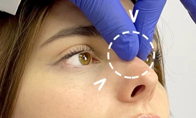 رینوپلاستی ثانویه