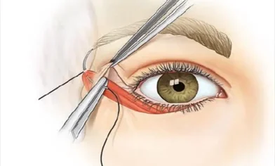 مراقبت‌های بعد از بلفاروپلاستی